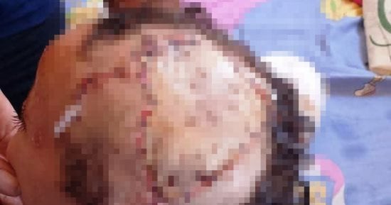 جراحة عاجلة ببنها التعليمي لطفل يعاني من انقلاع كامل لجزء من فروة الرأس