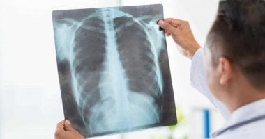 أصبت بالالتهاب الرئوى قبل كده؟.. اعرف أهمية لقاح المكورات الرئوية ومن يحتاجه لحماية الرئة