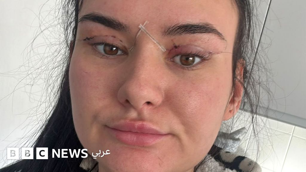 كيف تصبح بعض عمليات رأب الجفون "وصفة لكارثة"؟